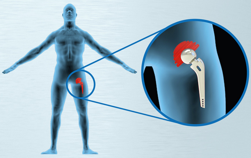 Lucidatura con rullo ECOROLL di una protesi d'anca